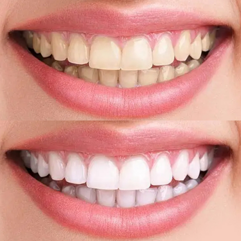 V34 Whitening Strips