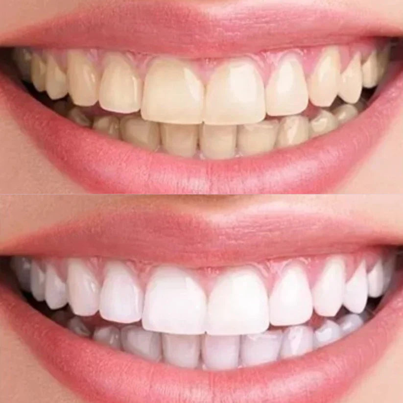 Premium Zahnbleaching Set